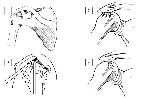 ACROMIONPLASTICA ARTROSCOPICA